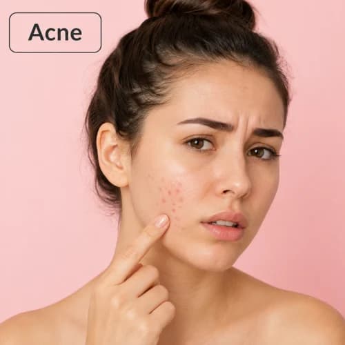 Acne